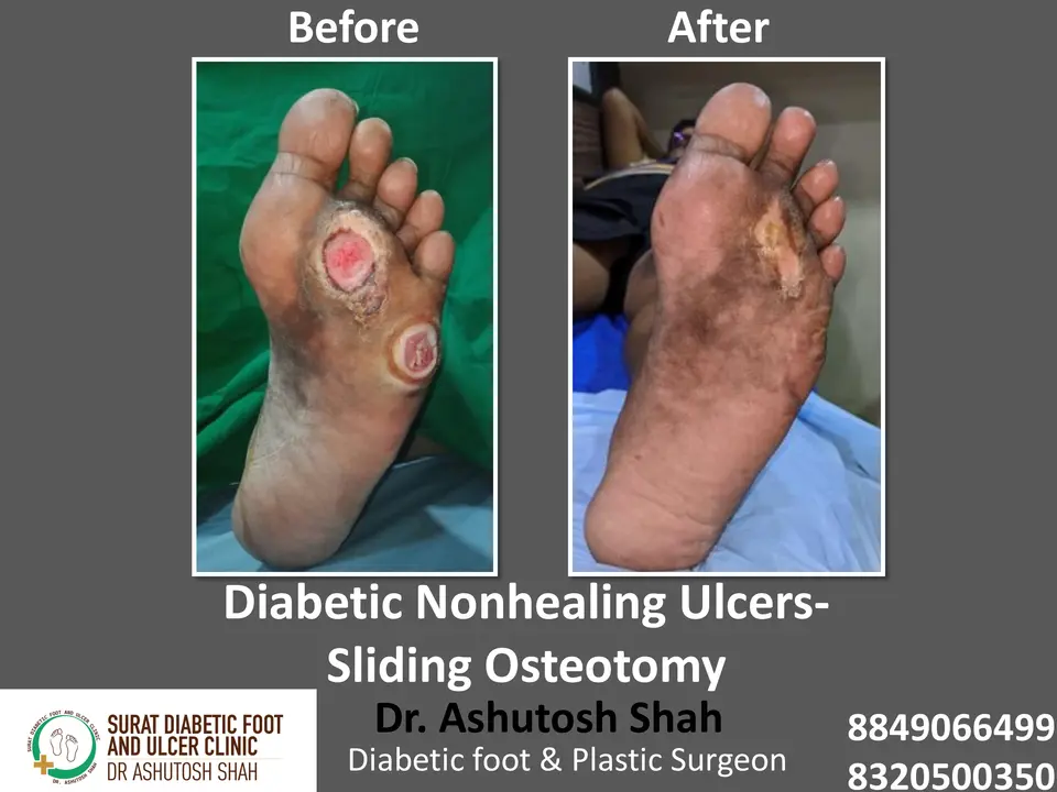 Diabetic Foot  PPT sunita.pptx-23.webp